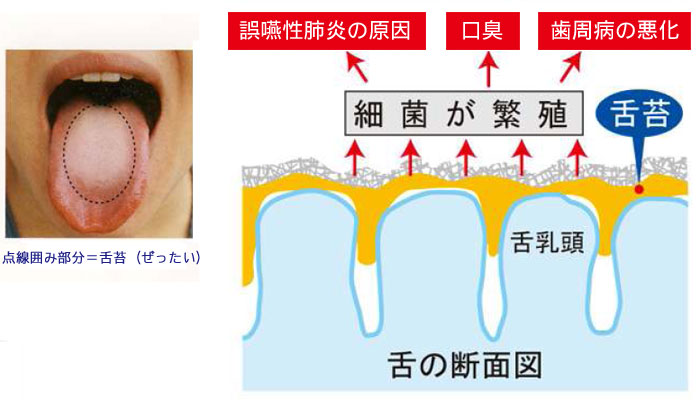 舌ブラシ W-1